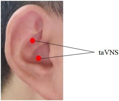 Altered functional connectivity of the thalamus in patients with <mark class="highlighted">insomnia disorder</mark> after transcutaneous auricular vagus nerve stimulation therapy